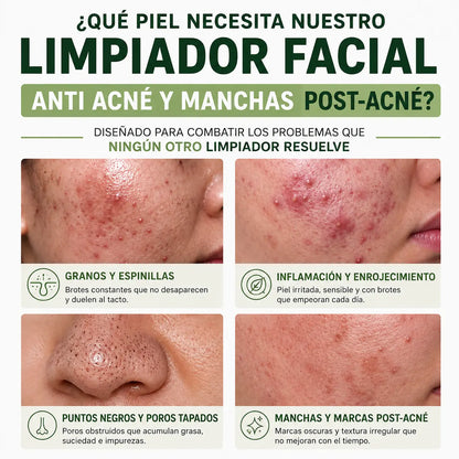 COMBATE GRANOS, ESPINILLAS Y MANCHAS POST-ACNÉ